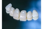 Металлокерамическая коронка  на задние зубы