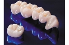 Металлокерамическая коронка  на зуб в стоматологии