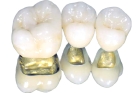 Недорогие металлокерамические коронки на зубы