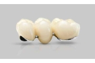 Дешевые металлокерамические коронки на зубы