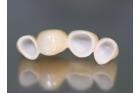 Коронка на зуб из диоксида циркония