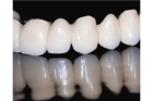 Коронки из диоксида циркония на передние зубы