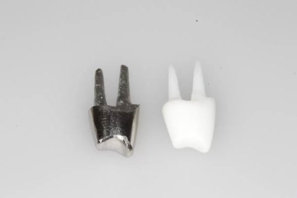 Культевая вкладка многокорневого зуба (разборная)