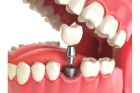 Протезирование верхних зубов