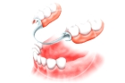 Зубные протезы на имплантах