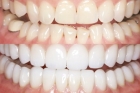 Реставрация нижних зубов